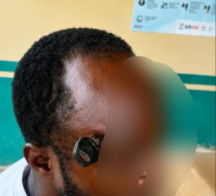 Man Receives Specialist Care at Korle Bu After Motorbike Key Driven Into Skull During Jasikan Okada Dispute