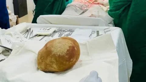 Trincomalee General Hospital Close-up shot of the giant yellow bladder stone