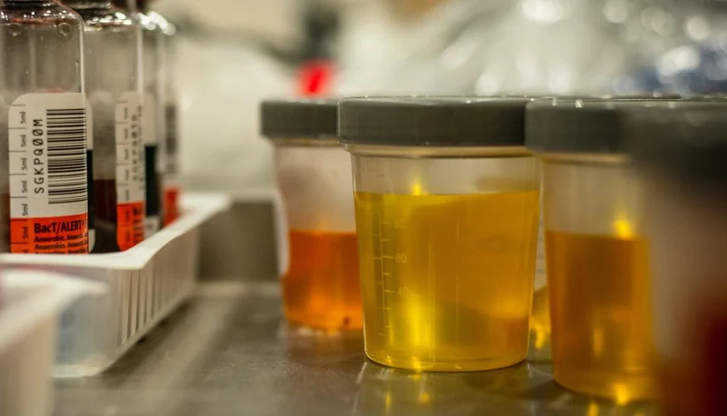University of Birmingham Researchers Develop Non-Invasive Urine Test to Detect Over 90% of Bladder Cancers