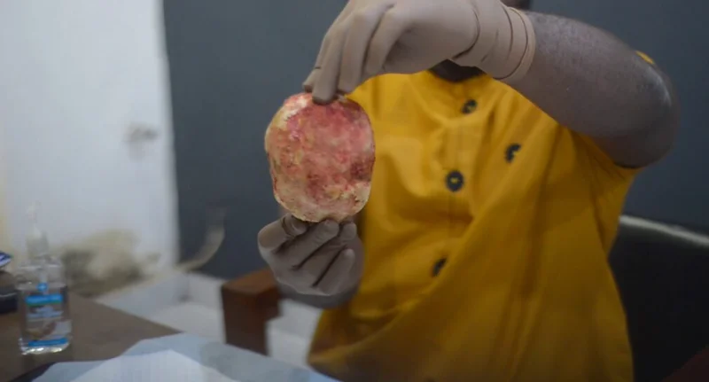A person wearing surgical gloves holds a massive, round bladder stone with a textured, yellowish-pink surface. The individual is dressed in a mustard-yellow scrub shirt, and a bottle of hand sanitizer is visible on a table in the background. The image depicts the 880g stone recently removed from a patient by doctors in Kumasi, Ghana.