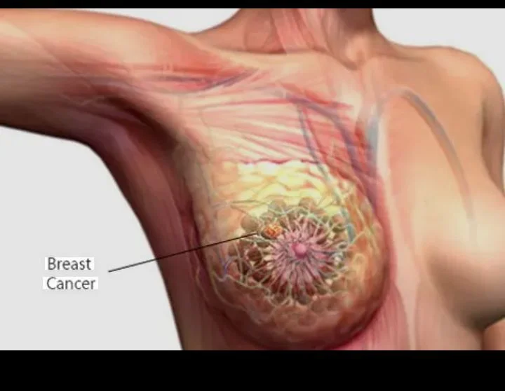Breast cancer remains leading cause of death for African women, says GLOBOCAN